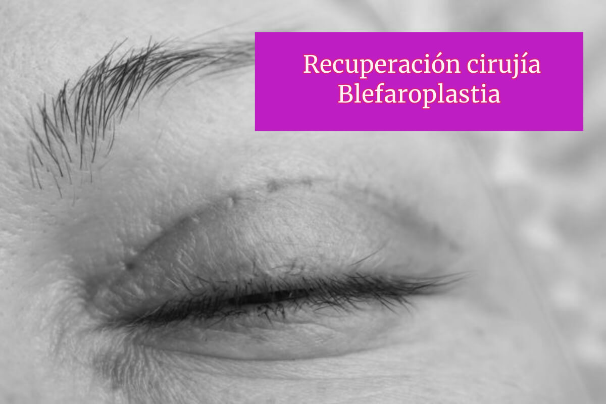 Recuperación cirujía Blefaroplastia