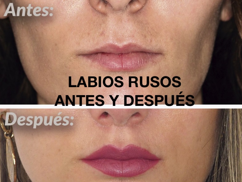 Los labios rusos son la tendencia más HOT en la estética 2026